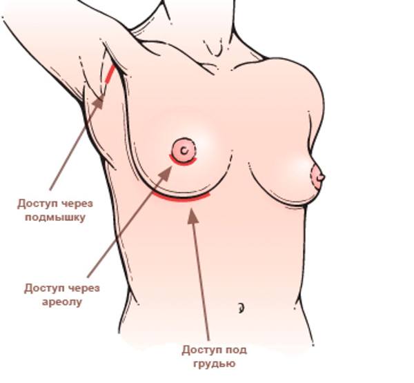 Остальные типы доступов в пластической операции на грудь