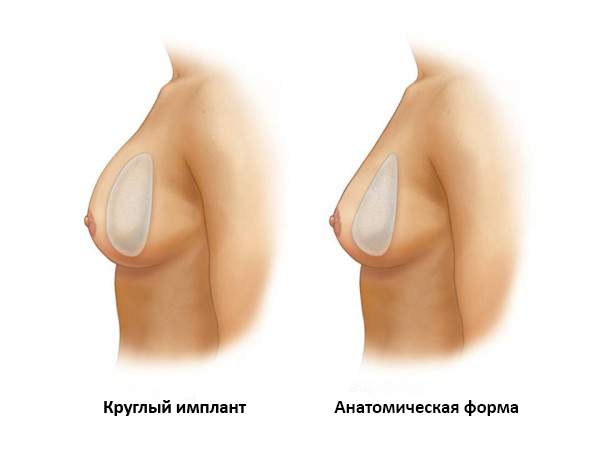 Различия в формах имплантов