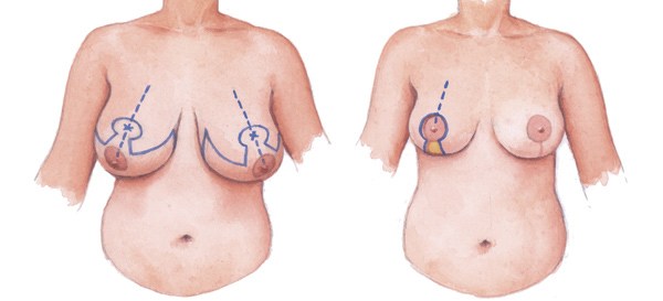 Рак железы: фото, диагноз, признаки и симптомы рака груди на разных стадиях РМЖ.