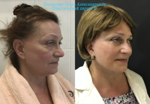 фото женщины до и после операции омоложения лица