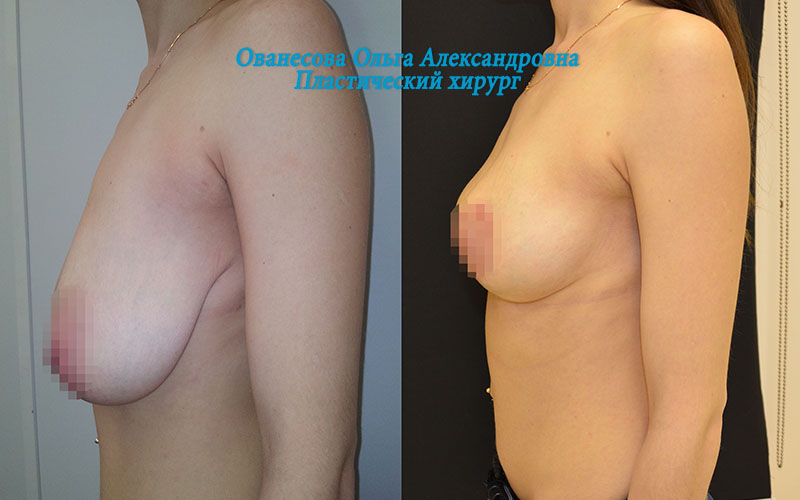 мастопексия без имплантов фото до и после