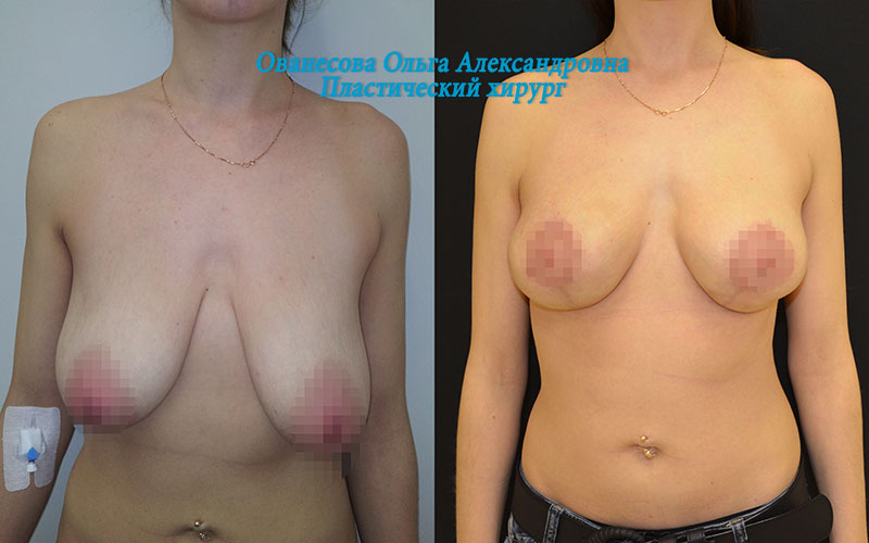 подтяжка груди без имплантов до и после фото