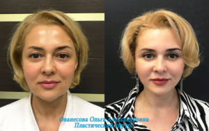 женщина до и после пластики лица