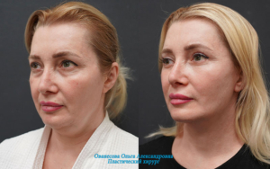 Фото до и после подтяжки лица