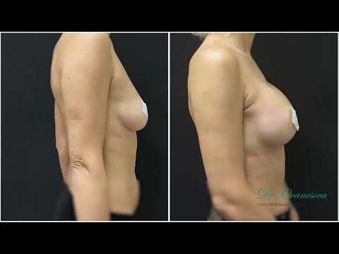 Увеличение груди. До и после. Пациент Н5