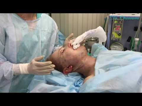 Подтяжка лица и шеи. В операционной после операции. Пациент 32.