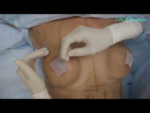 Увеличение груди. Начало операции(2). Пациент Н3