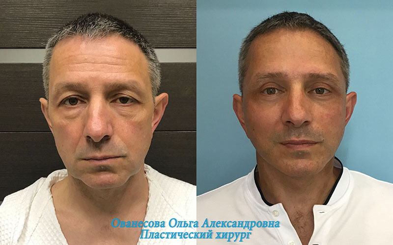 мужчина до и после подтяжки лица фото