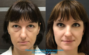суфы на лице - до и после